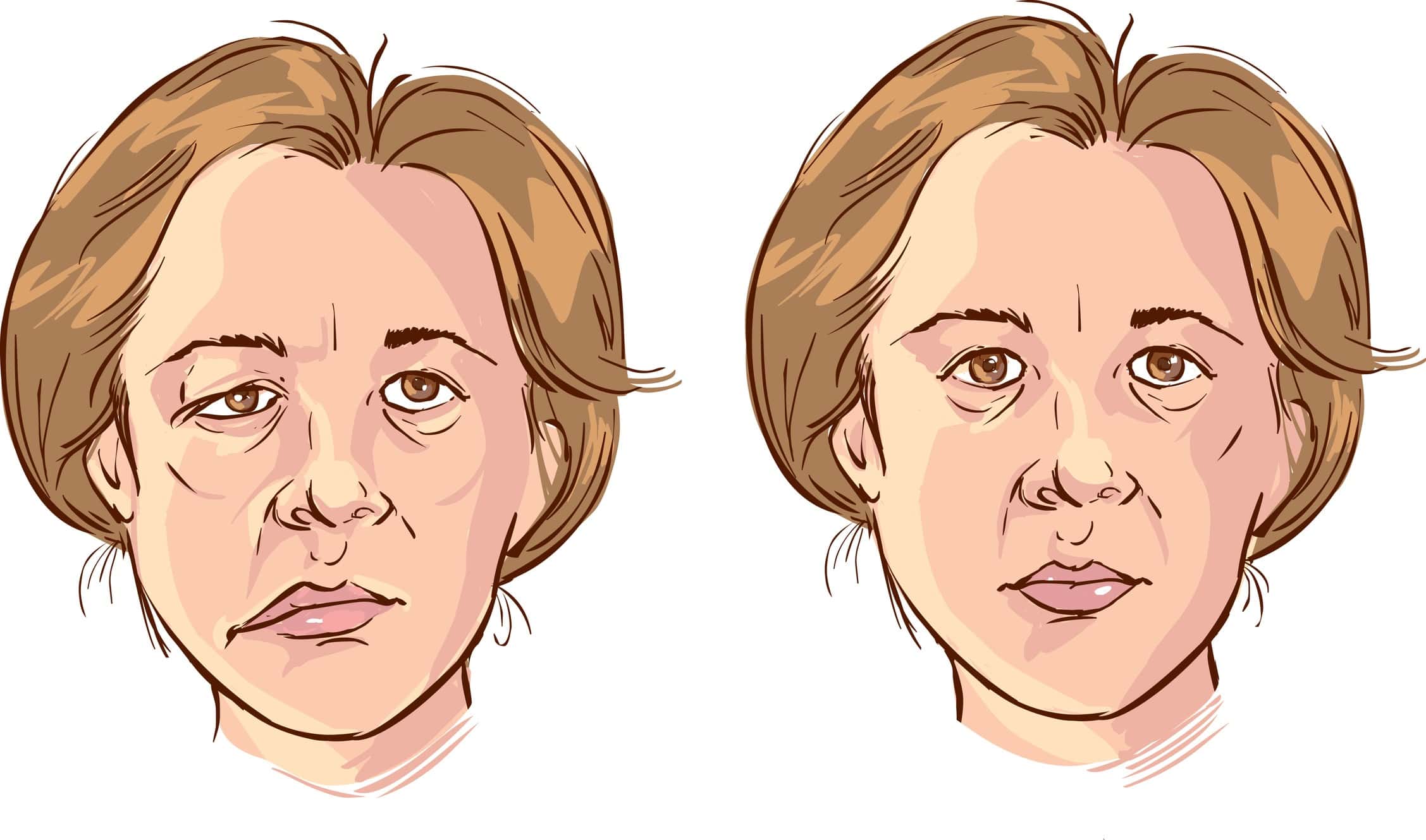 Acupuncture Treatment for Bell’s Palsy