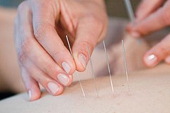 Acupuncture Needles