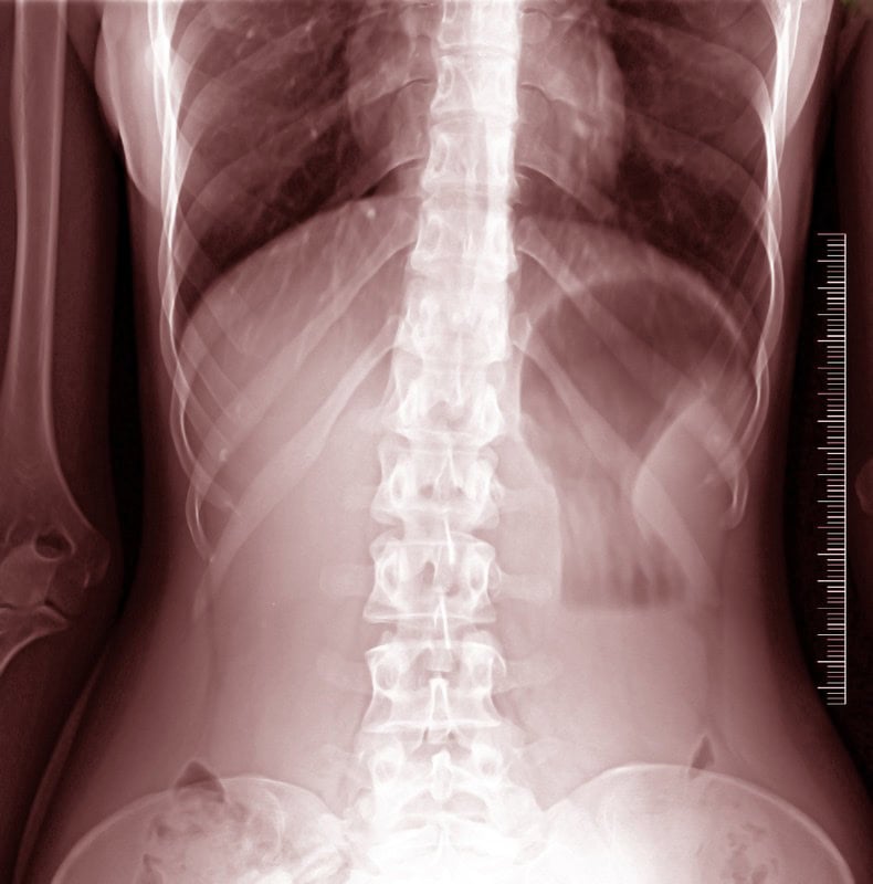 Understanding Chiropractic Care and Exercise for Adult Scoliosis