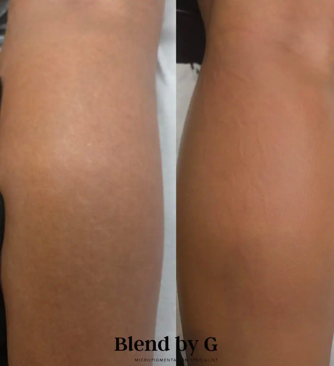 Skin texture improvement showing smoother, clearer skin after treatment at Blend by G.