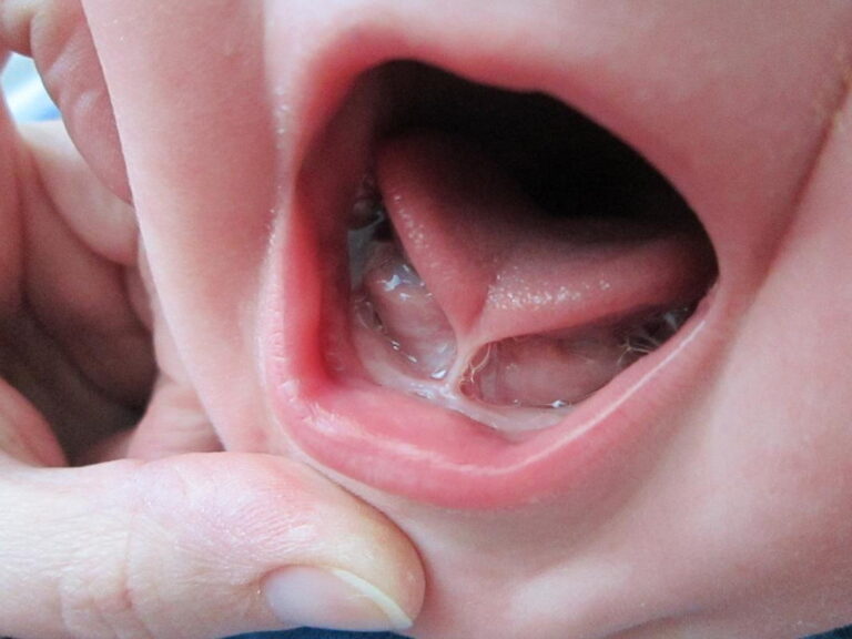 Tongue tie in a baby, the lingual frenulum visible as a tight band under the raised tongue