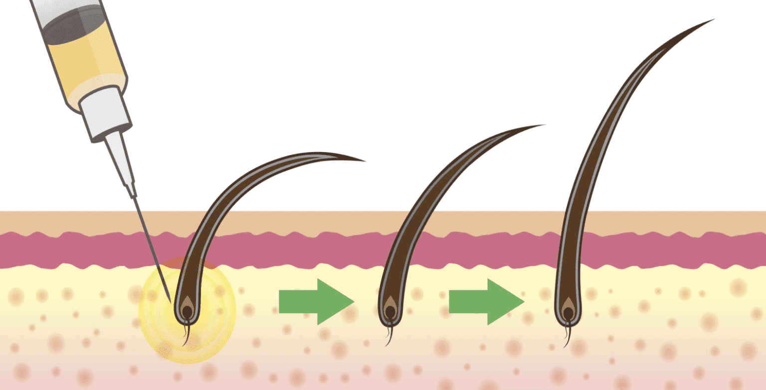 Stem Cell Therapy for Hair Loss Developments