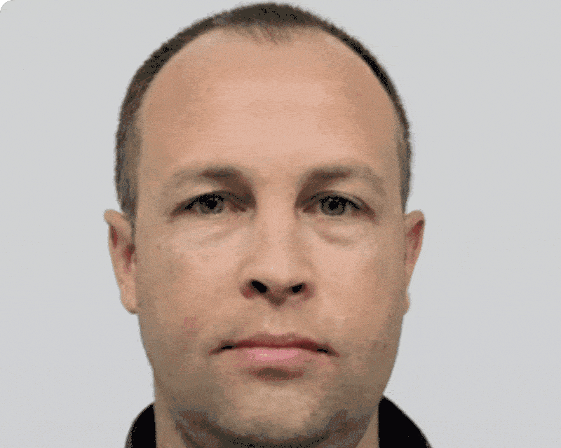 a Houston hair transplant before and after photos