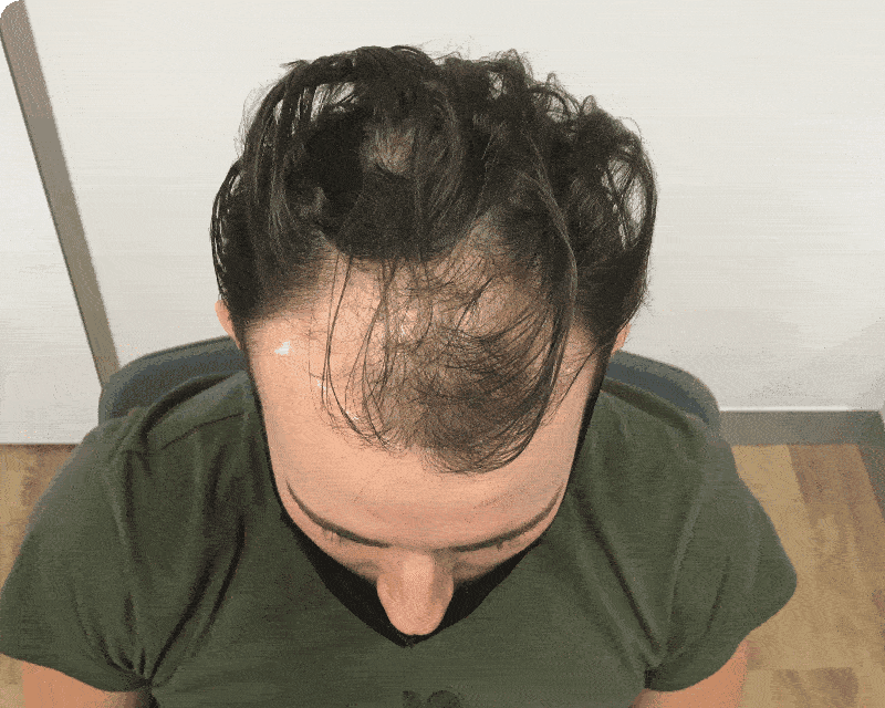a Greenwood Village hair transplant before and after photos