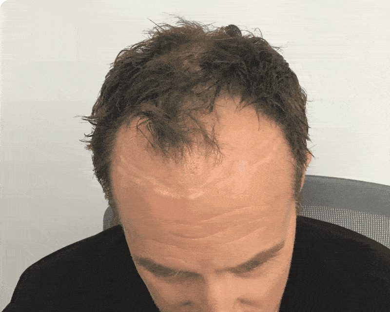 before and after photos of a hair transplant in Denver