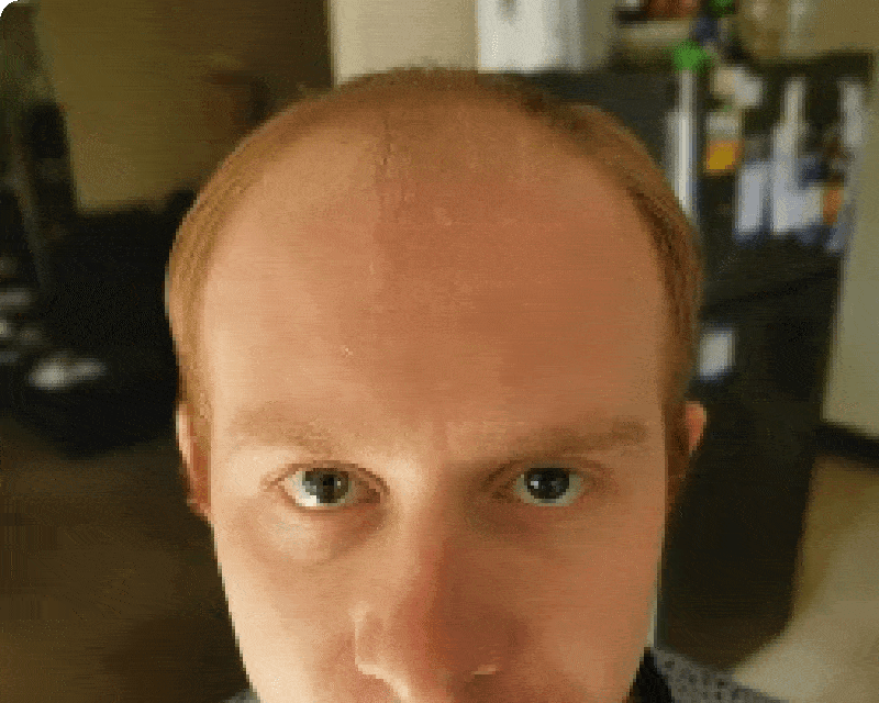 before and after an FUE hair transplant in Denver