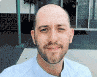 a Scottsdale hair transplant before and after photos