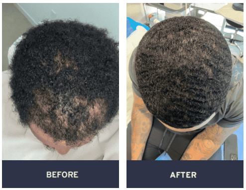 before and after photos of stem cell hair restoration