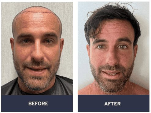 FUE Hair Transplant Before and After