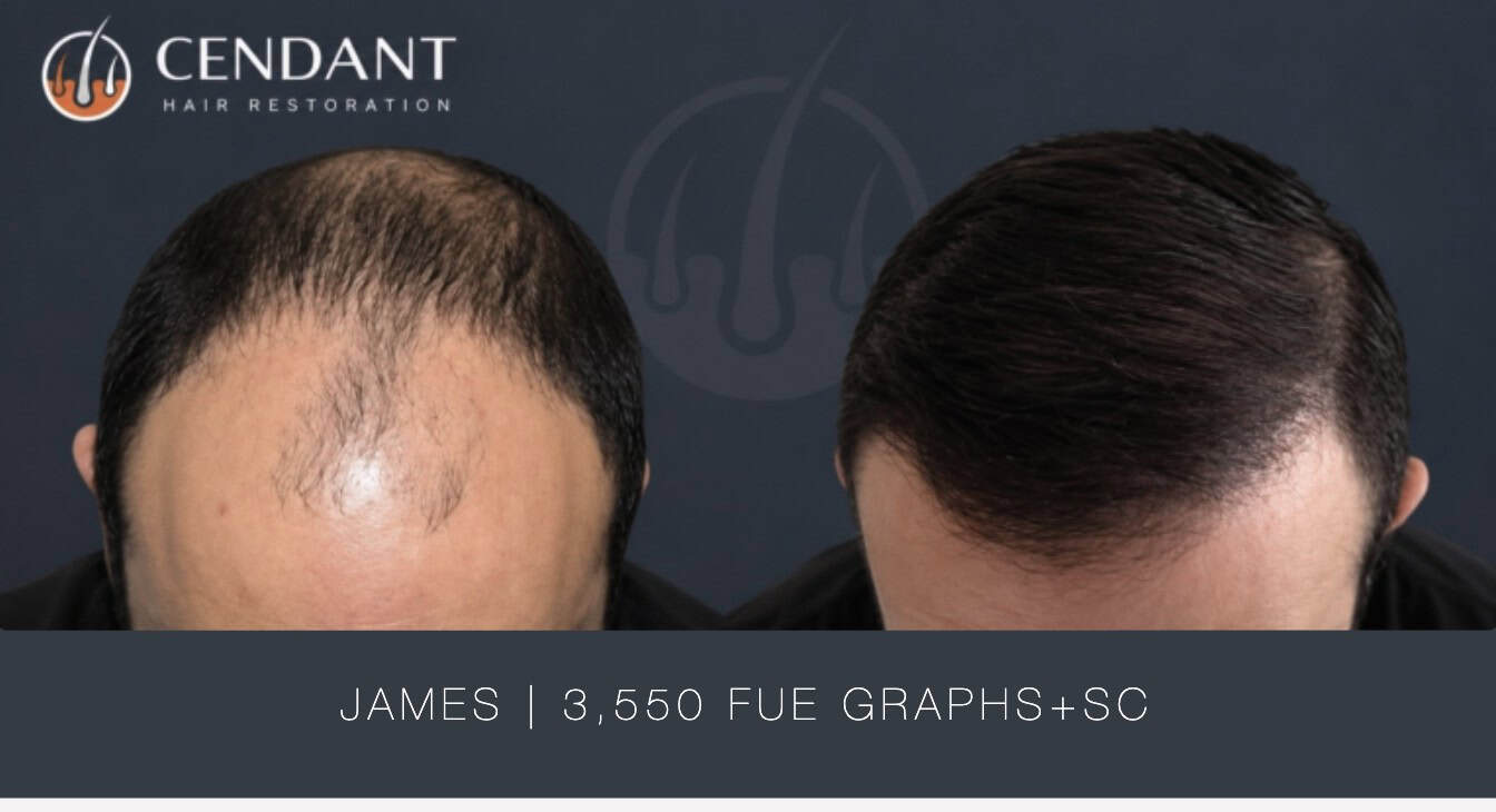 James | 3,550 FUE Graphs+SC
