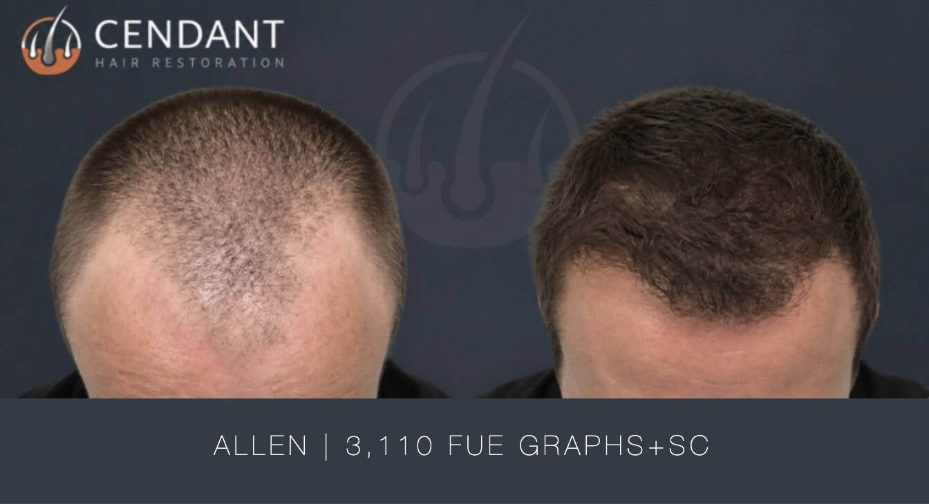 Allen 3,110 FUE Graphs+SC