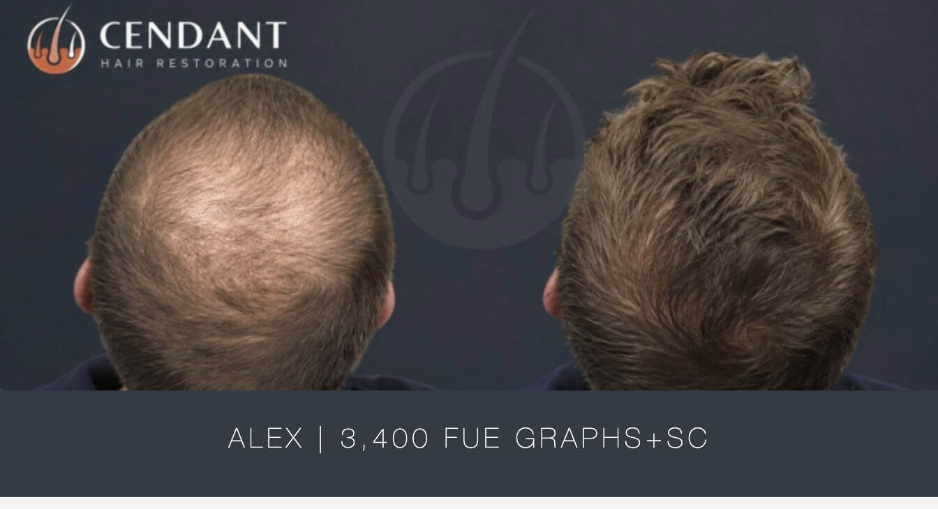 Alex 3,400 FUE Graphs+SC