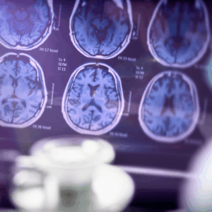 Close-up of a diagnostic monitor displaying brain MRI or CT scans, used to evaluate cognitive decline and aid in an Alzheimer's diagnosis.