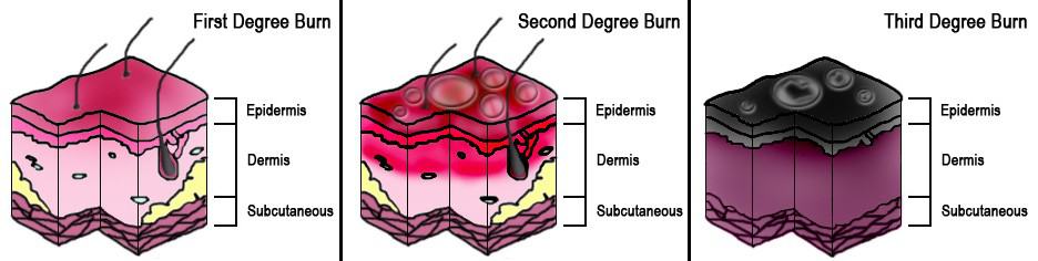 Burn Diagram