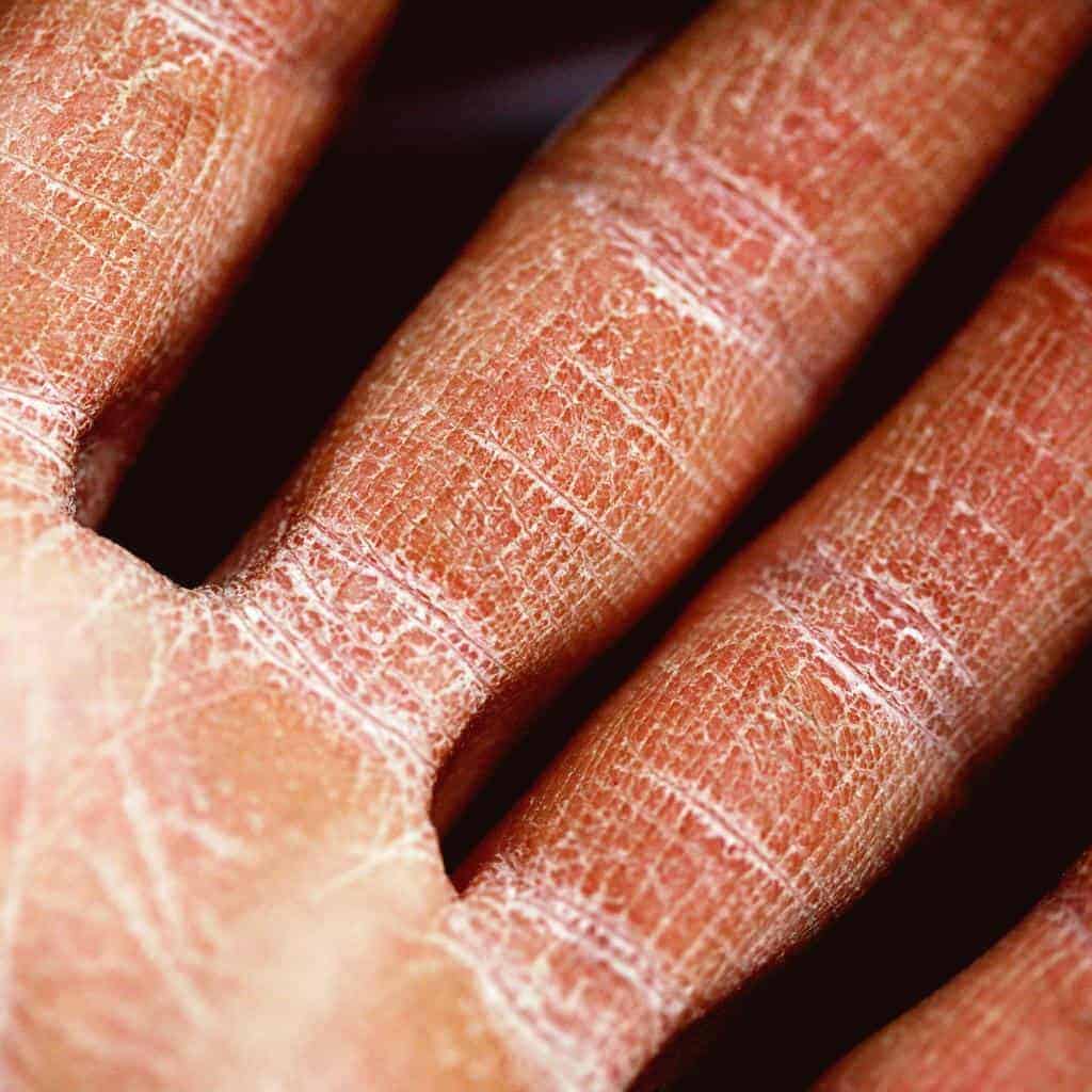 How to Treat Eczema