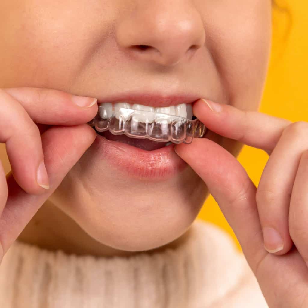 Pros And Cons Of Braces And Invisalign