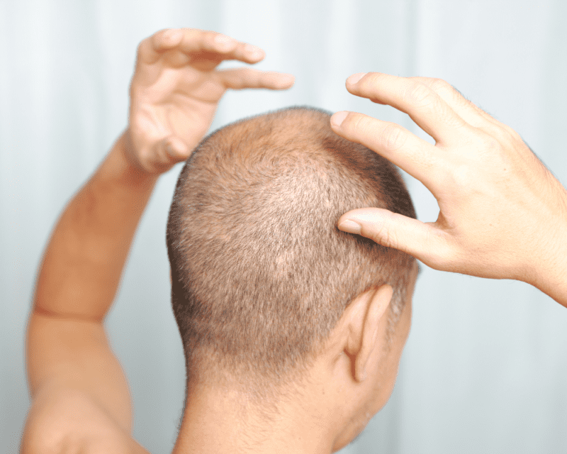 After Hair Loss