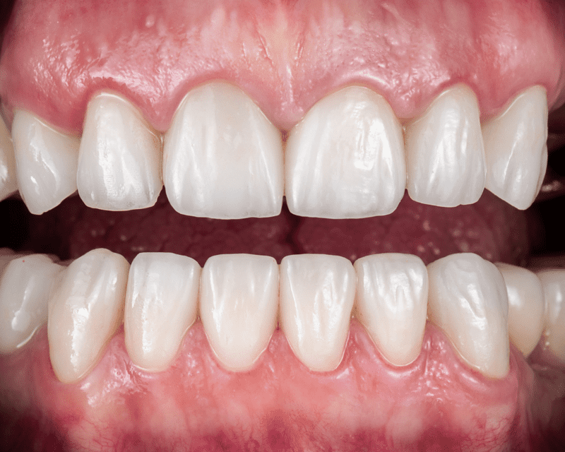 porcelain veneers porcelain veneers