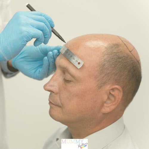 Hair transplantation