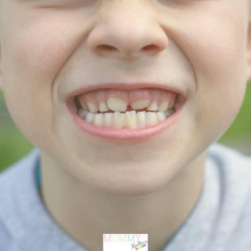 Signs Your Child Needs Braces