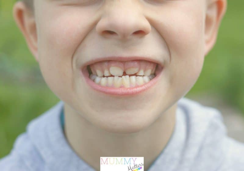 Signs Your Child Needs Braces