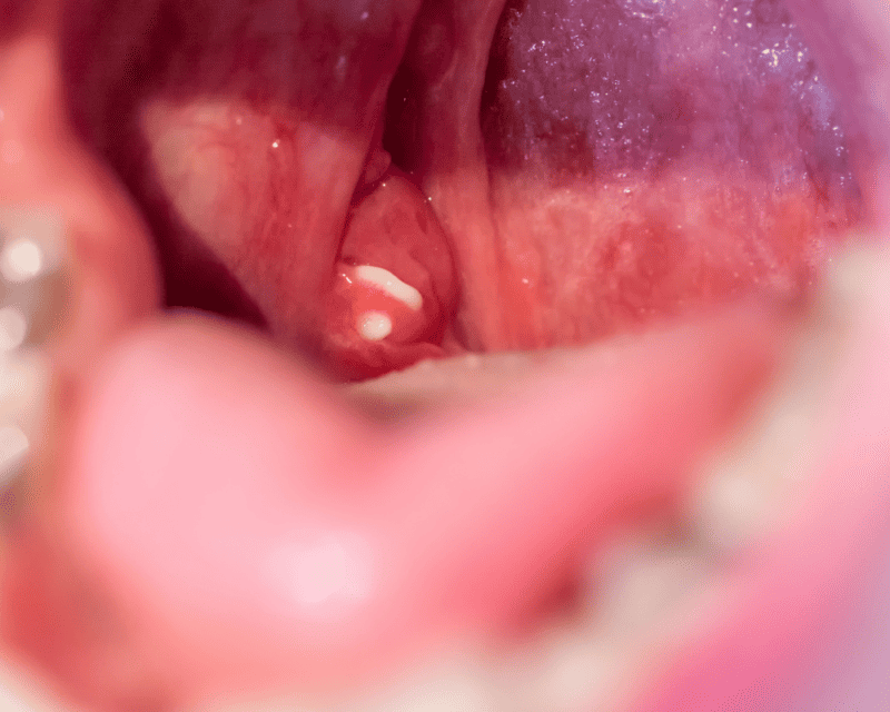 Tonsillectomy