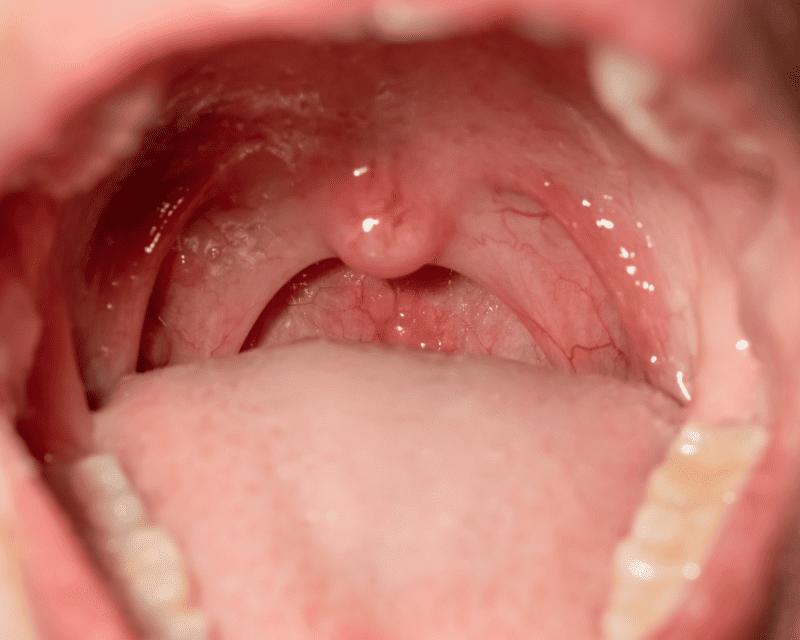 Tonsils