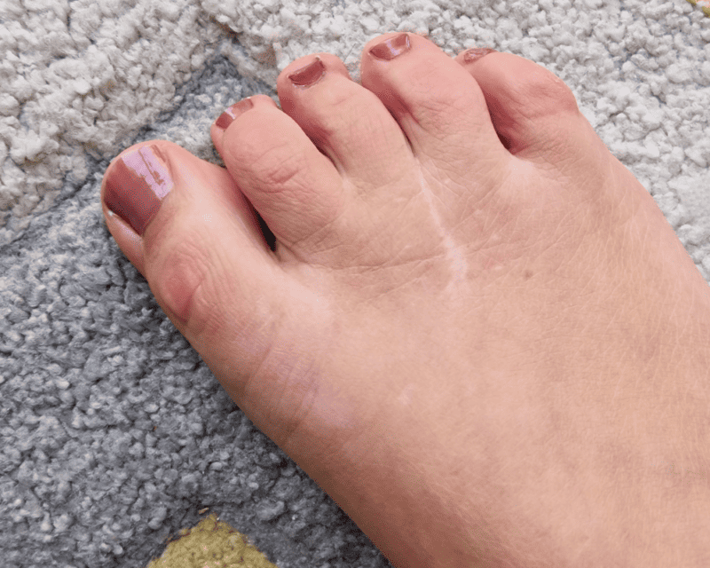 Morton's Neuroma Surgery Morton's Neuroma Surgery