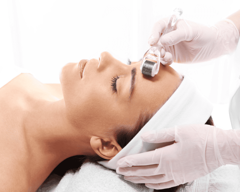 microneedling microneedling