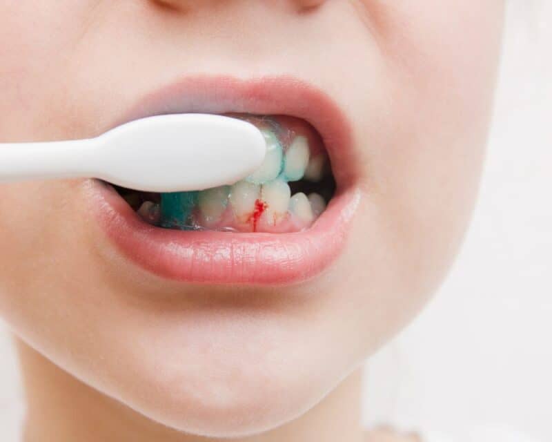 bleeding gums gums when pregnant