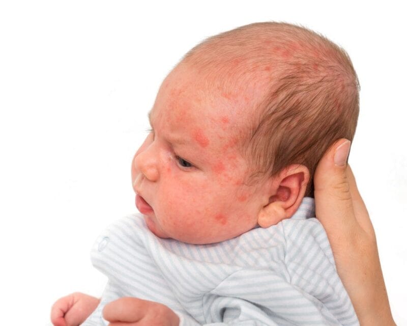 Baby eczema