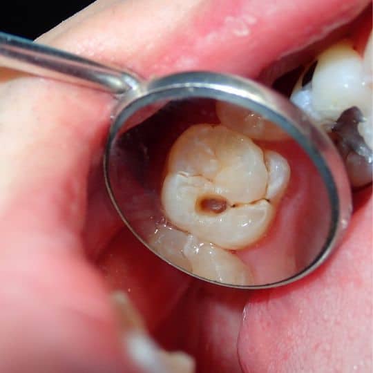 Dental decay