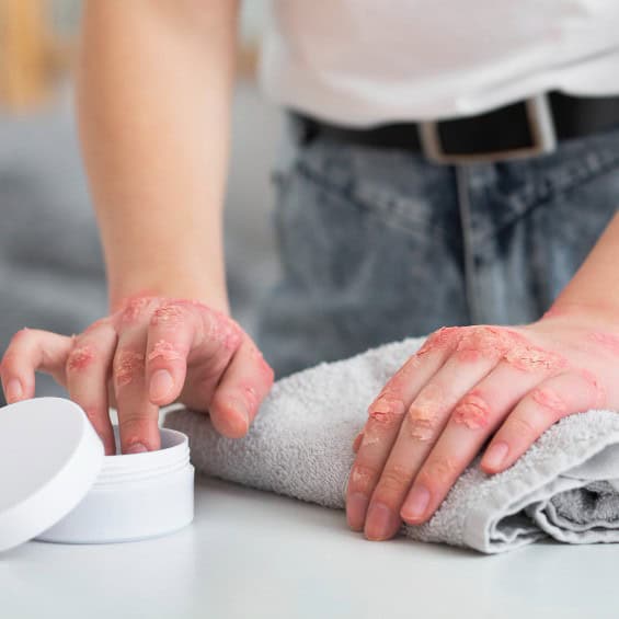 ayurvedic treatment of eczema
