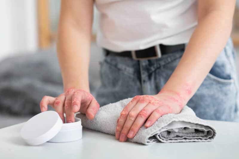 ayurvedic treatment of eczema