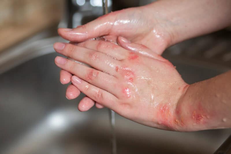 ayurvedic treatment of eczema