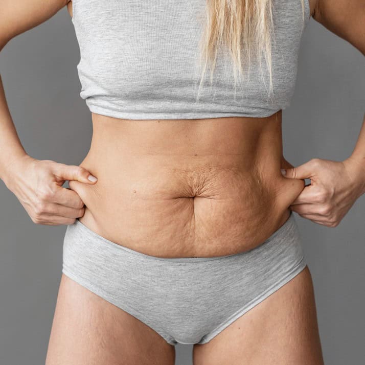How Does a Mini Tummy Tuck Differ from a Full Tummy Tuck
