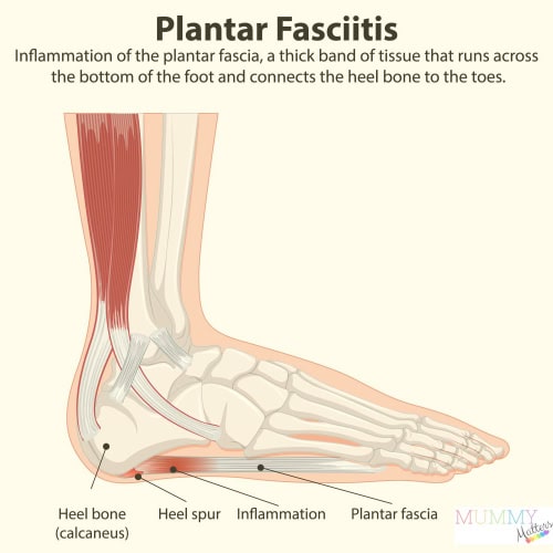 Plantar Fasciitis