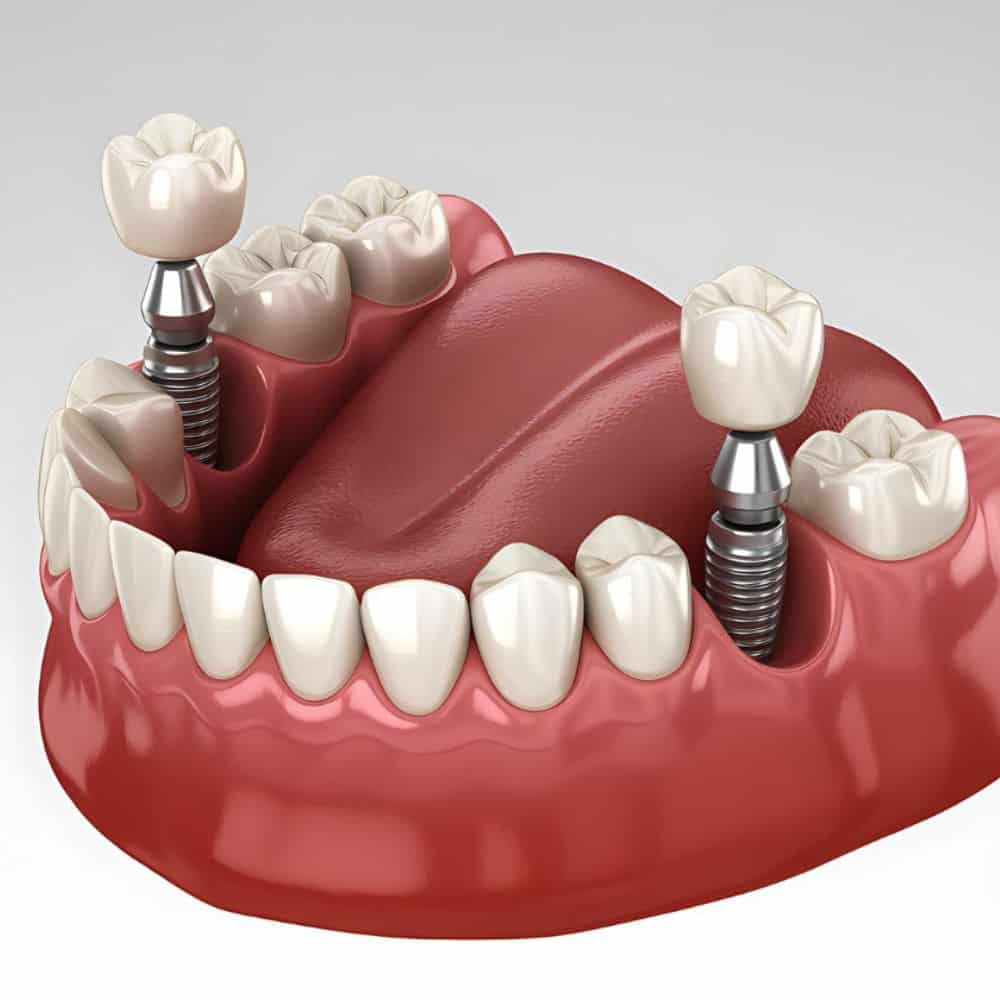 Healthy Dental Implants