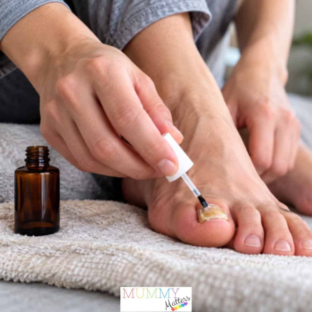 Toenail Fungus