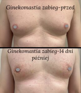 ginekomastia przed i po gdynia, gdańsk