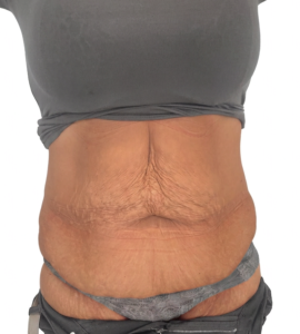 abdominoplastyka przed i po