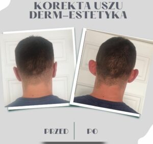 otoplastyka przed i po