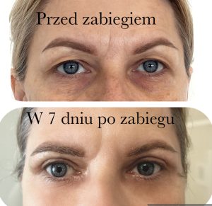 blefaroplastyka przed i po, plastyka powiek przed i po, korekta powiek, przed i po