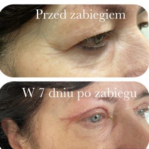 plastyka powiek przed i po zabiegu, blefaroplastyka 