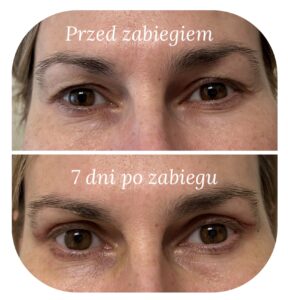 Blefaroplastyka powiek przed i po