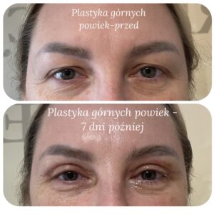 Blefaroplastyka powiek górnych Gdynia