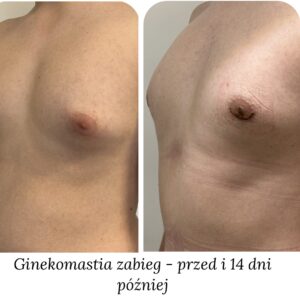 Ginekomastia zabieg przed i po