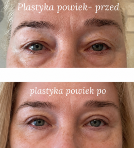 Plastyka powiek – efekt przed i po zabiegu , plastyka powiek gdynia, plastyka powiek gdańsk, zabieg na opadającą powiekę efekty