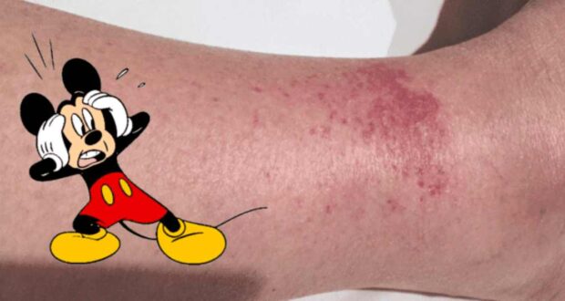 Disney Rash