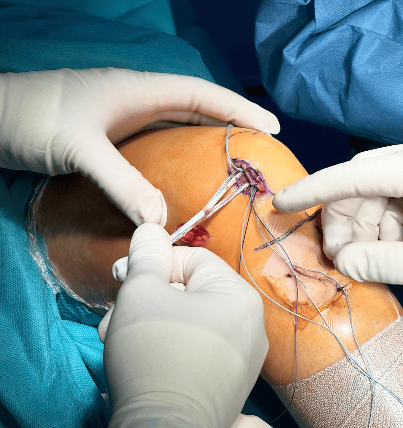 Reconstrucție ligamentară cu grefă la nivelul rotulei